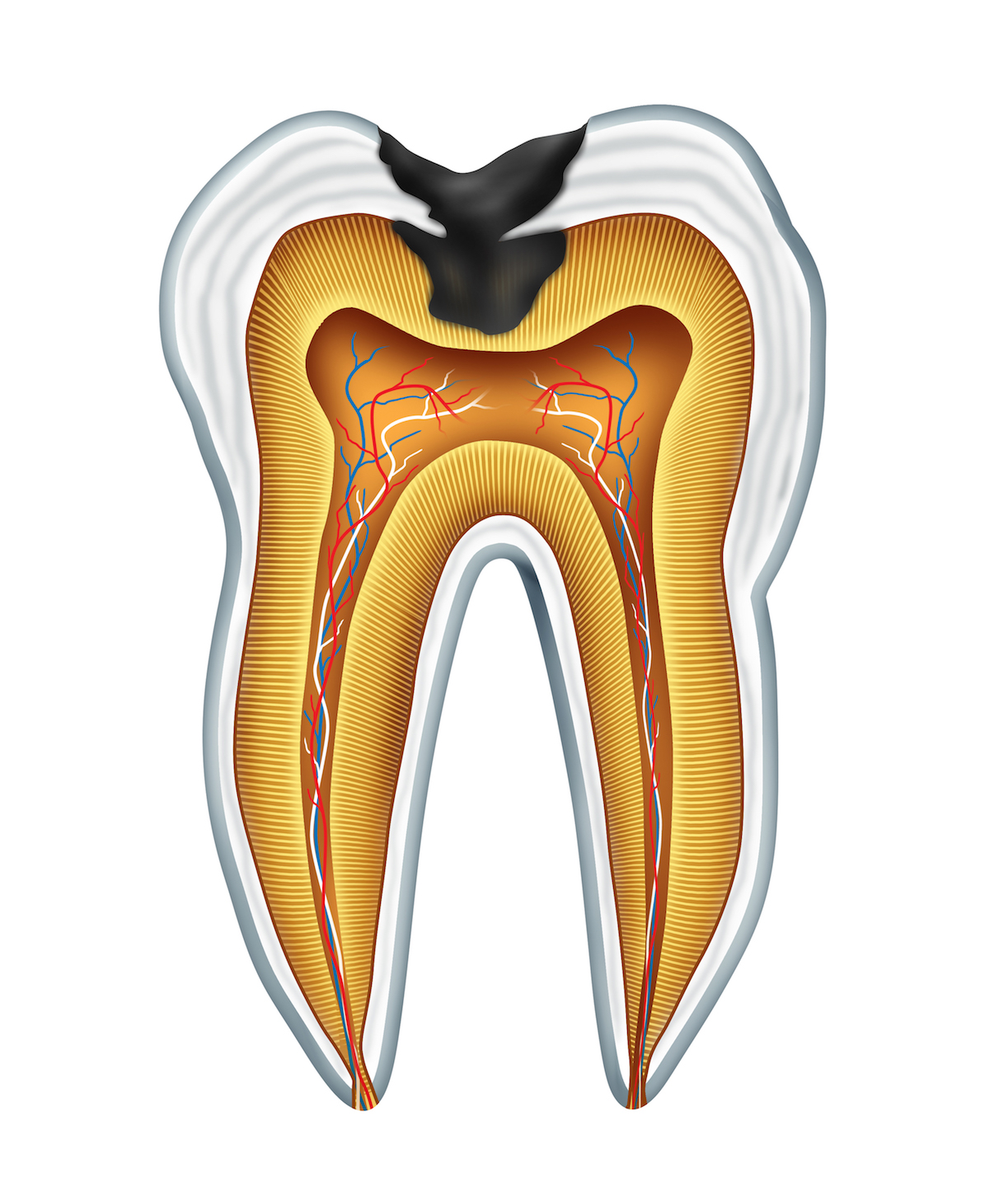 endodoncija, lečenje kanala korena, vađenje živca, pulpitis, gangrena zuba