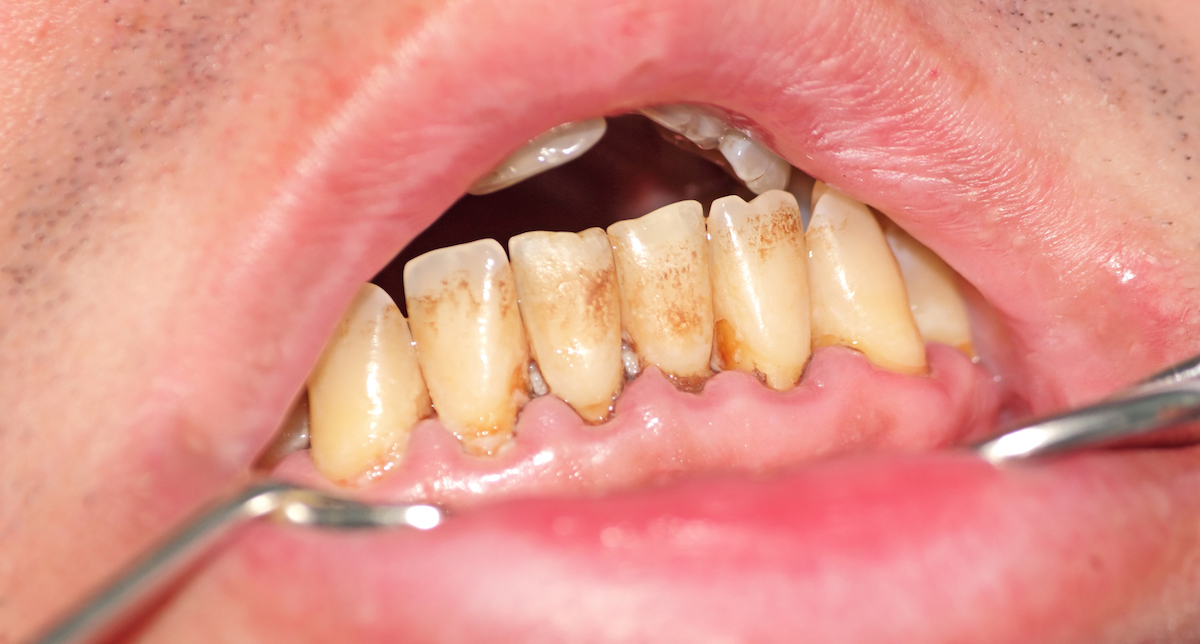 parodontopatija, parodontologija, parodontalni džep, povlačenje desni